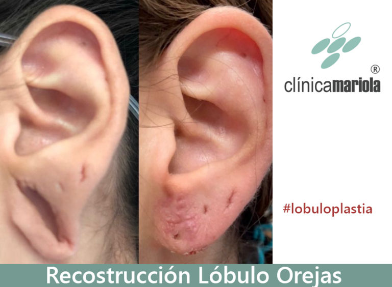 Lobuloplástia en Alcoy – Cierre de agujero en lóbulo oreja – Clínica de